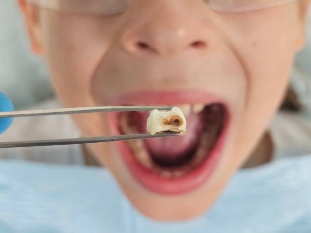 Best Emergency Dentist for Lost Fillings or Crowns in Jacksboro, TN